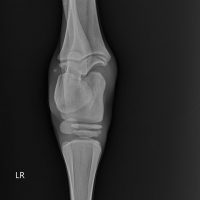 Ap Tibiotarsal Joint Admission Edit