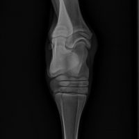 Tibiotarsal Improved Ossification