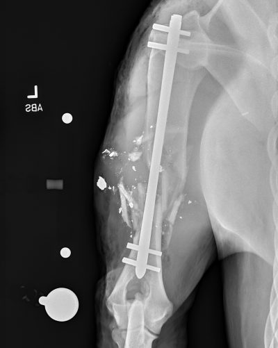 822570 Cc Humerus Fx 00Wks Crop