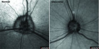 Canine Optic Nerve Normal V Glaucoma Resize