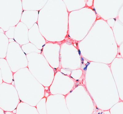 Extravascular Fibrin Deposits