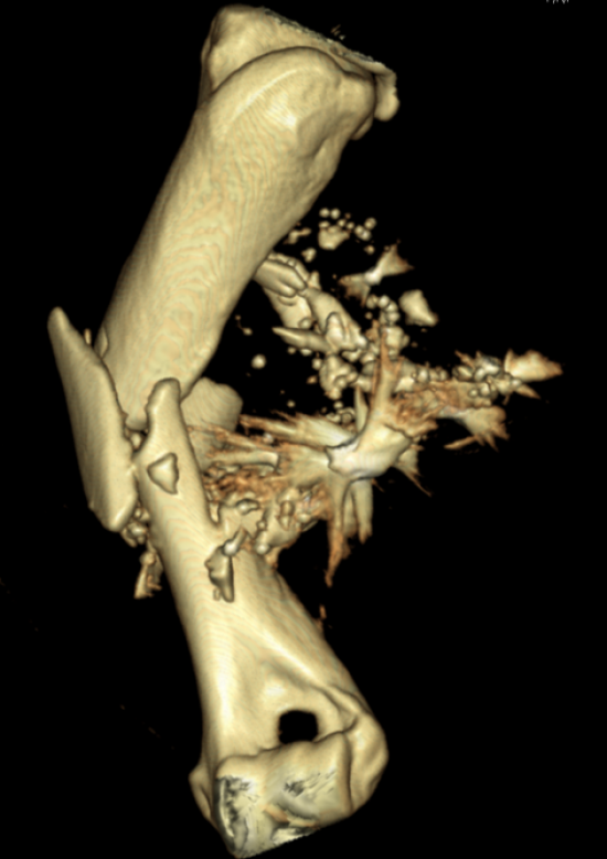822570 Humeral Fx Mino Pre Op 3 D