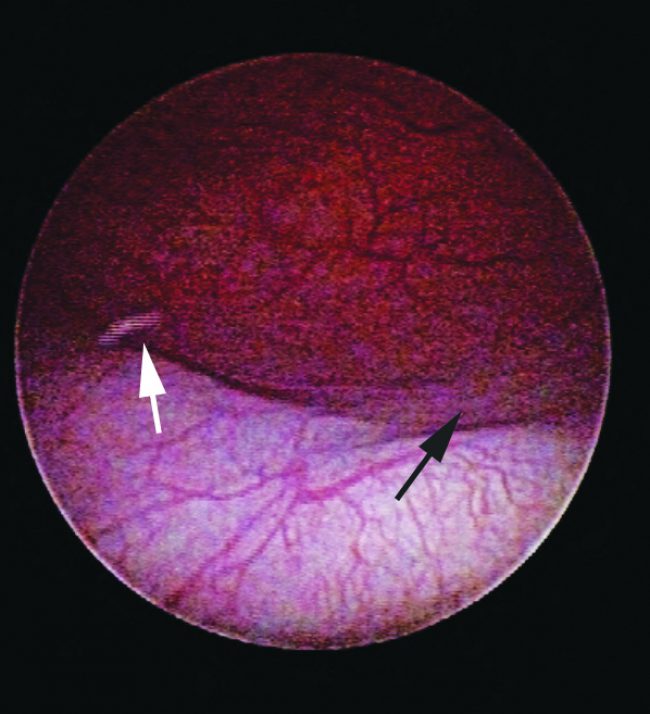Laser Ablation of an Intramural Ectopic Ureter in a Labrador Retriever