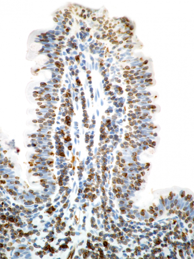 Differentiating Feline Intestinal Lymphoma from Inflammatory Bowel ...