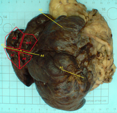 Liver Lobe With Mass