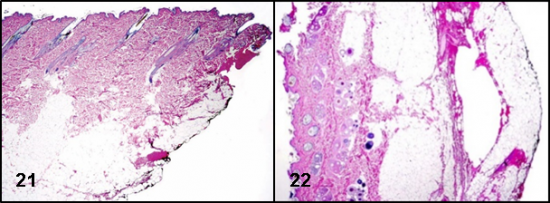 Surgical Margins Figs 21 22 Microscopic Evaluation