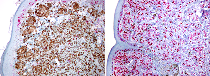 choroidal melanoma pathology