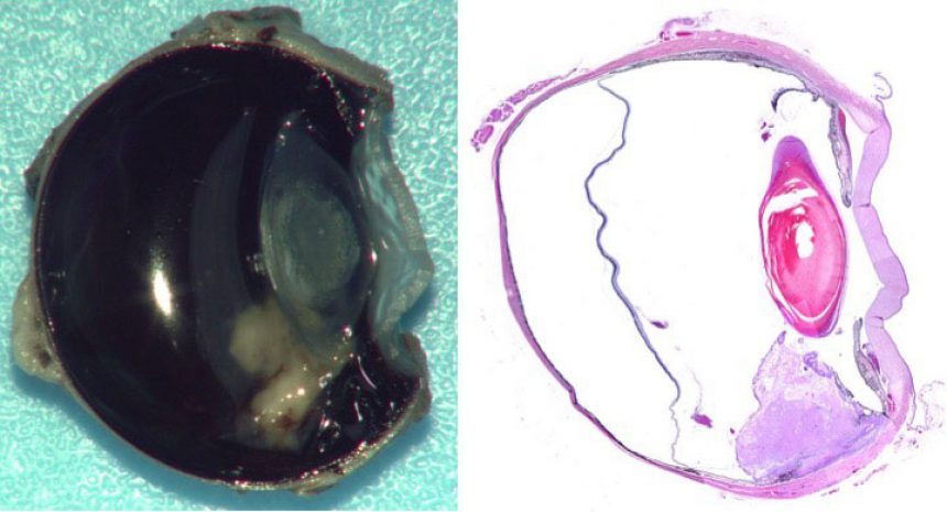 Iridociliary Adenoma