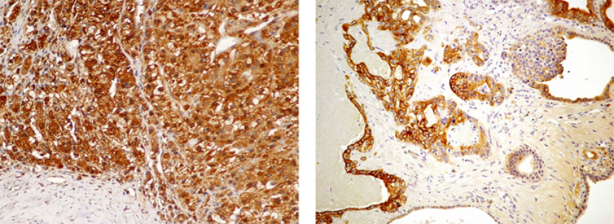 Liver Labeling For Hep Par 1 And Ck7