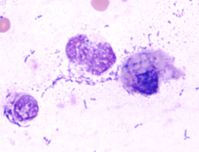 Clinical Pathology Lysed Nuclei And Extracellular Bacteria