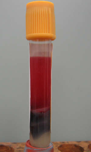 Clinical Pathology Hemolyzed Serum